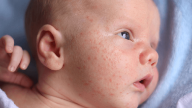 Baby:2zuci6nibv8= Allergic Reaction Rash