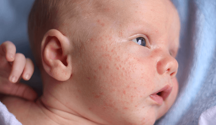 Baby:2zuci6nibv8= Allergic Reaction Rash